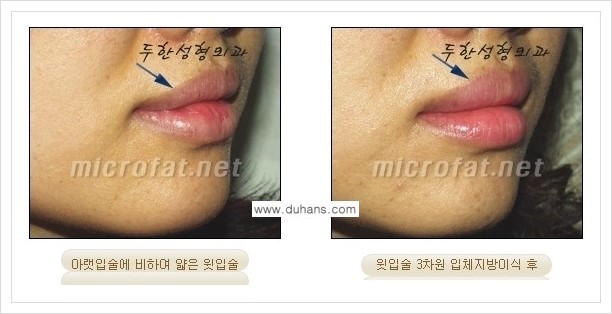 [두한성형외과 경쟁력 미세지방이식] - [입술 미세지방이식 안내 2.] 관련 이미지 9