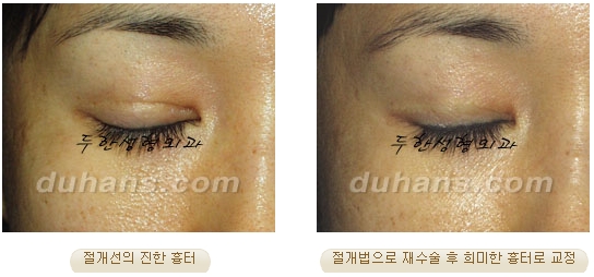 [두한성형외과 쌍커풀재수술] - [쌍커풀재수술 수술방법과 쌍커풀재수술 성공요건] 관련 이미지 43