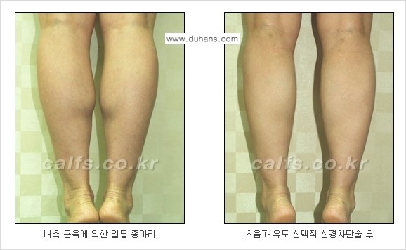 [두한성형외과 경쟁력 종아리성형] - [초음파 유도 선택적 신경차단술 안내 ③] 관련 이미지 10