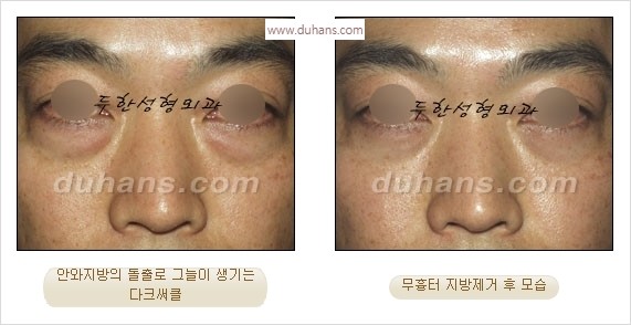 ⁠⁠[두한성형외과 경쟁력 안검성형] - [젊은 눈매를 위한 윗눈꺼풀 지방제거, 눈밑 지방제거] 관련 이미지 31