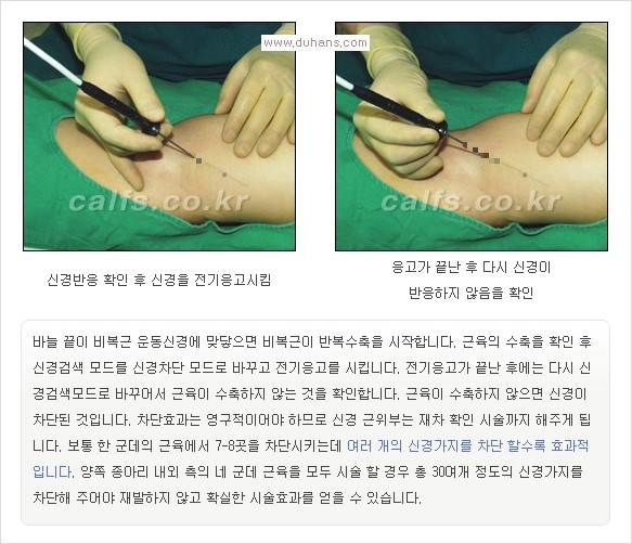 [두한성형외과 경쟁력 멀티종아리성형] -  [종아리 축소술의 여러 가지 종류] 관련 이미지 18