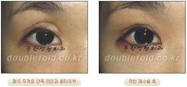쌍꺼풀수술 두한성형외과 - 쌍커풀재수술의 문제점 관련 이미지 24
