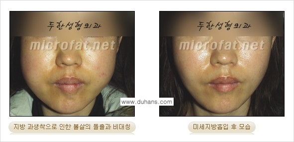 [두한성형외과 경쟁력 미세지방이식] - [미세지방이식 부작용 종류와 교정방법 안내] 관련 이미지 8