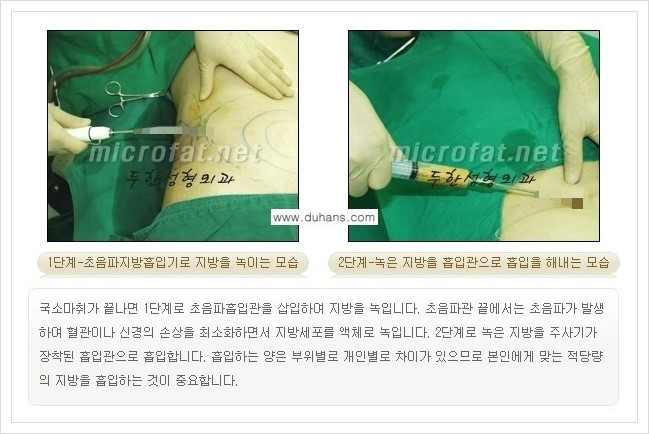 [두한성형외과 경쟁력 맞춤 바디성형] - [간편한 아랫배, 윗배, 허리, 옆구리살, 허벅지, 엉덩이, 복부지방흡입술, 팔뚝(상완부) 지방흡입술 안내] 관련 이미지 6