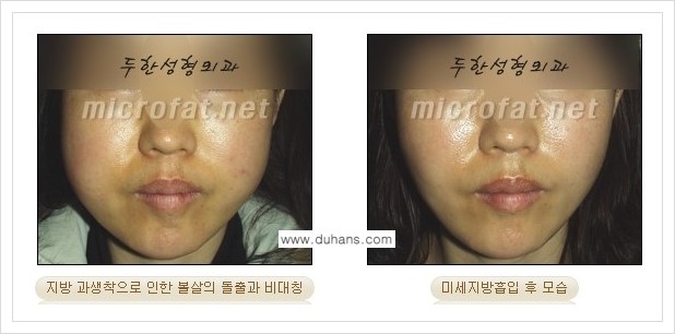 [두한성형외과 경쟁력 지방이식] - [지방이식 부작용 - 지방이식 후 지방이식 과다주입, 과다생착의 교정 안내] 관련 이미지 1
