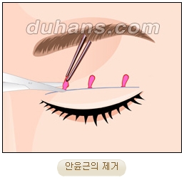 눈성형잘하는곳 두한성형외과 - 겹쌍꺼풀 관련 이미지 9