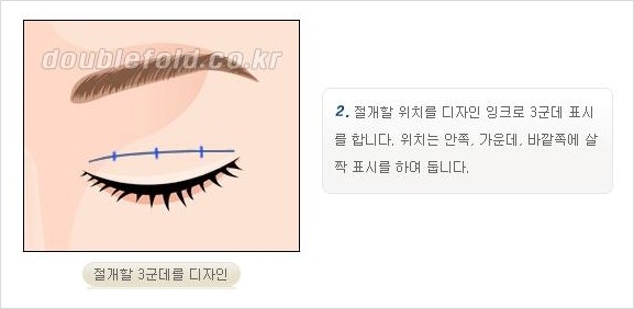[두한성형외과 경쟁력 쌍꺼풀 재수술, 극한 재수술] - [쌍꺼풀 재수술의 과정 안내 2.] 관련 이미지 5
