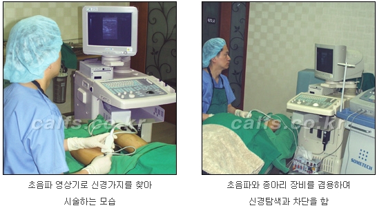 [두한성형외과 종아리퇴축술] - [NO절개! 초음파유도신경차단술] 관련 이미지 13