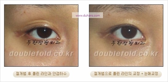 [두한성형외과 경쟁력 쌍꺼풀 재수술] - [풀린 라인 교정(Correction released fold line) 방법] 관련 이미지 6