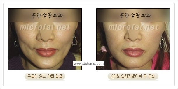 [두한성형외과 경쟁력 윤곽성형] - [볼, 볼살 지방이식] 관련 이미지 13