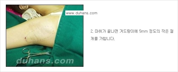 [두한성형외과 성형 FOCUS 지방흡입] - [액취증 - 다한증 초음파 컷터 지방흡입 ③] 관련 이미지 9