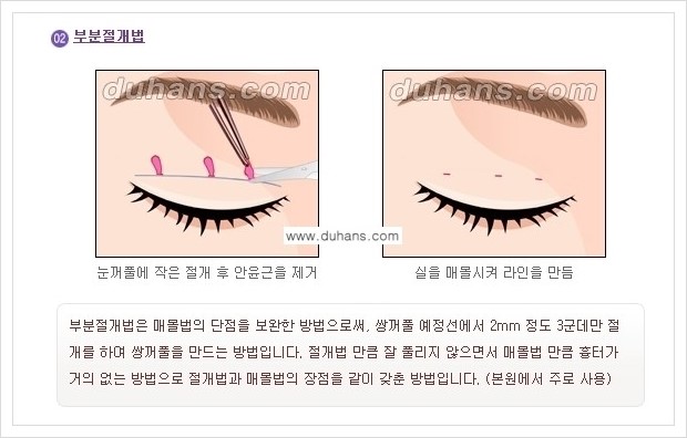 [두한성형외과 경쟁력 눈성형] - [아름답고 자연스러운 눈매를 위한 퀵쌍꺼풀 안내] 관련 이미지 6
