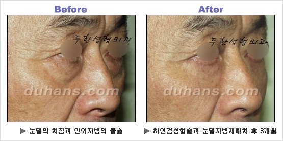 [두한성형외과 경쟁력 동안성형 리더] - ​[미간주름, 이마주름, 안검성형, 이마거상술, 눈썹거상술] 관련 이미지 92