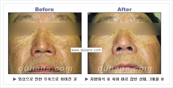 [두한성형외과 경쟁력 코성형] - [코높힘 미세지방이식 정보 안내] 관련 이미지 3