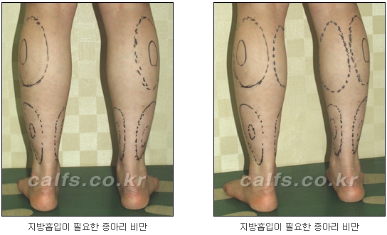 두한성형외과 지방흡입 - 부위별 안전 지방흡입 관련 이미지 28