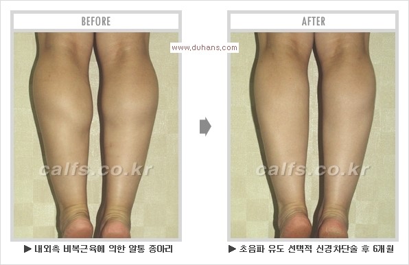 [두한성형외과 경쟁력 멀티종아리성형] - [알통종아리 해결 - 비절개 초음파 선택적 신경차단술] 관련 이미지 20