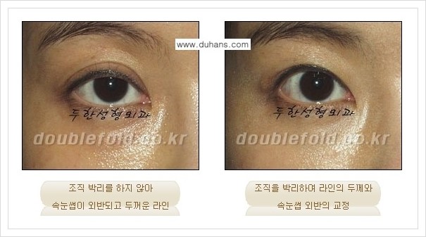 [두한성형외과 경쟁력 쌍꺼풀(눈) 재수술] - [쌍꺼풀(눈) 재수술, 극한 재수술 클리닉의 특성] 관련 이미지 3