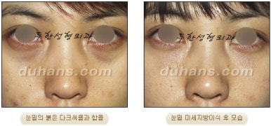 두한성형외과 눈밑성형 - 눈밑지방제거, 눈밑주름, 눈밑지방재배치 관련 이미지 65
