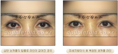 [두한성형외과 쌍커풀수술] - [쌍꺼풀지방이식] 관련 이미지 38