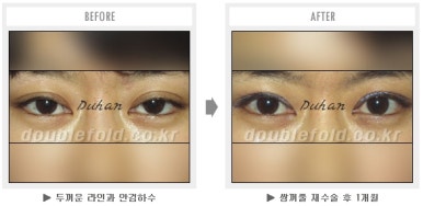 두한성형외과 쌍커풀 재수술 - 짝눈 눈매교정, 가성 안검하수 교정과 뒤밑트임 관련 이미지 52