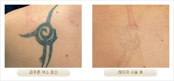 [두한성형외과 경쟁력 안전성형] - [최첨단 장비를 이용한 흉터, 점, 주근깨, 잡티, 문신제거 레이저 시술] 관련 이미지 33