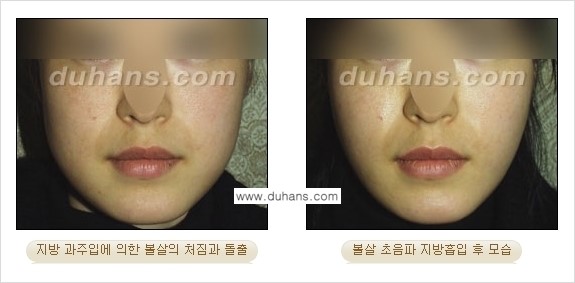 ​​​﻿[두한성형외과 경쟁력 간편지방흡입] - [볼살지방흡입, 턱선지방흡입 시술 과정의 안내] 관련 이미지 12