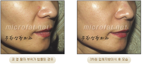 [Duhan Plastic Surgery Face Autologous Fat Grafting] - [Noble Surgery and Indian Band Fat Grafting] image 19