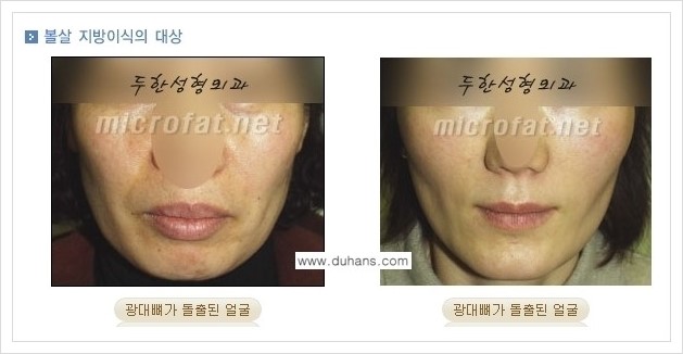 ⁠⁠[두한성형외과 경쟁력 볼살지방이식] - [심하게 야윈 주름이 있는 얼굴, 역삼각형 협소한 얼굴, 광대뼈가 돌출되어 보이는 경우 안내] 관련 이미지 1