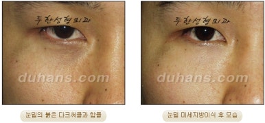 두한성형외과 눈밑성형 - 눈밑지방제거, 눈밑주름, 눈밑지방재배치 관련 이미지 88