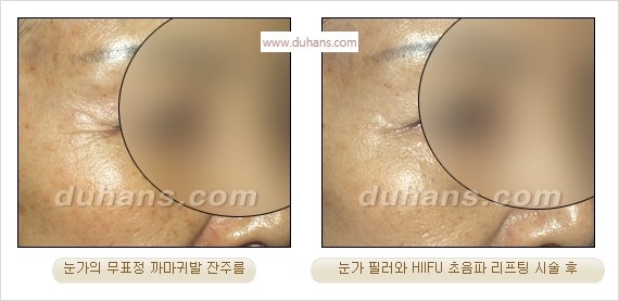 [두한성형외과 경쟁력 주름성형] - [주름제거를 위한 리프팅] 관련 이미지 54