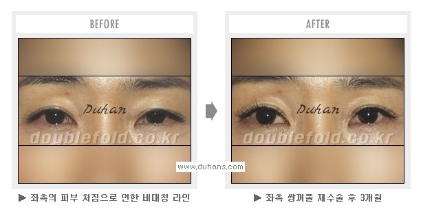 [두한성형외과 Dr. 컬럼] - [쌍꺼풀 재수술(눈 재수술)의 목적] 관련 이미지 5