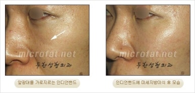 [Facial Autologous Fat Grafting, Duhan Plastic Surgery] - [Indian Wrinkle] image 13