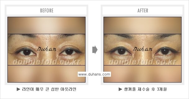 [두한성형외과 쌍꺼풀 재수술] - [쌍꺼풀 재수술에서 잘못된 수술로 인한 넓어진 흉터 처리 문제] 관련 이미지 3
