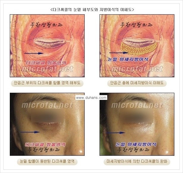 [두한성형외과 경쟁력 눈밑성형] - [눈밑 다크써클, 눈밑 주름의 교정 안내 1.] 관련 이미지 14