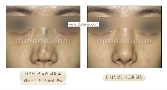 [두한성형외과 경쟁력 미세지방이식] - [코 지방이식 2.] 관련 이미지 9