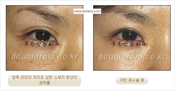 [두한성형외과 경쟁력 쌍꺼풀 재수술] - [두꺼운 라인을 교정하는 극한 재수술(Extreme Rroperation)] 관련 이미지 4
