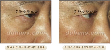 Blepharoplasty, Duhan Plastic Surgery - Upper and Lower Eyelids image 30