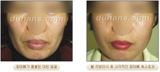 [두한성형외과 얼굴자가지방이식] - [볼살, 이마, 측두부] 관련 이미지 17