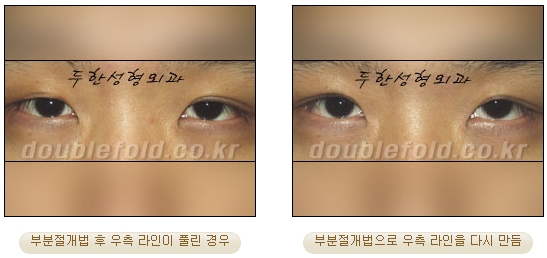 [두한성형외과 눈재수술] - [부분절개법 재수술] 관련 이미지 42