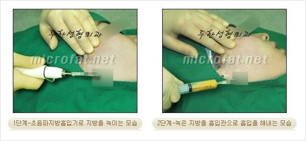 ​[두한성형외과 경쟁력 지방이식] - [지방이식 부작용 이후 마이크로 지방흡입, 마이크로 지방흡입 이후 부작용 없는 지방이식 방법] 관련 이미지 3