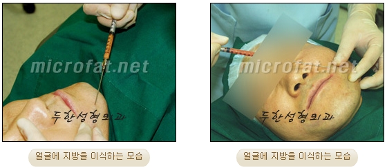 [두한성형외과 지방이식] - [타병원의 지방이식 부작용 교정] 관련 이미지 18