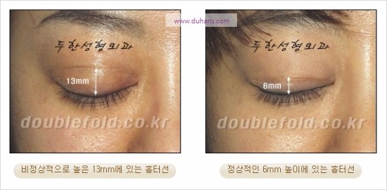 [두한성형외과 경쟁력 눈성형] - [쌍꺼풀 재수술에 대한 최선의 대안 제시] 관련 이미지 4