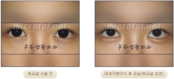 ​[두한성형외과 지방이식] - [애교살] 관련 이미지 14