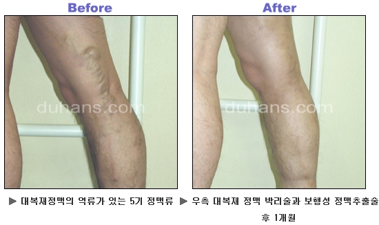 [두한성형외과 정맥류] - [하지정맥류, 정맥확장증, 혈관확장증] 관련 이미지 43