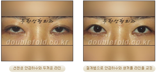 [Duhan Plastic Surgery Secondary Double Eyelid Surgery] - [Sleepy Eye Appearance, Asymmetrical Eye Appearance, Ptosis] image 15