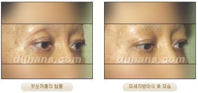 [Duhan Plastic Surgery Micro Fat Grafting] - [Upper Eyelids] image 9