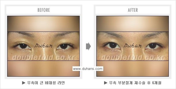 [두한성형외과 쌍꺼풀 재수술] - [피부 여유분이 부족해서 토안증이 발생한 경우] 관련 이미지 4