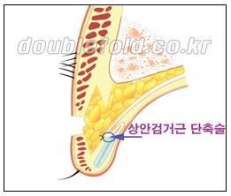 [두한성형외과 쌍수] - [재수술 실패의 원인, 재수술의 성공 요건] 관련 이미지 10