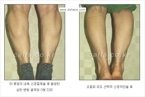 [두한성형외과 경쟁력 종아리성형] - [초음파 유도 선택적 신경차단술 안내 ④] 관련 이미지 11