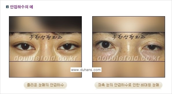[두한성형외과 경쟁력 눈성형] - [안검하수(졸린 눈매) 재수술 안내 ②] 관련 이미지 2